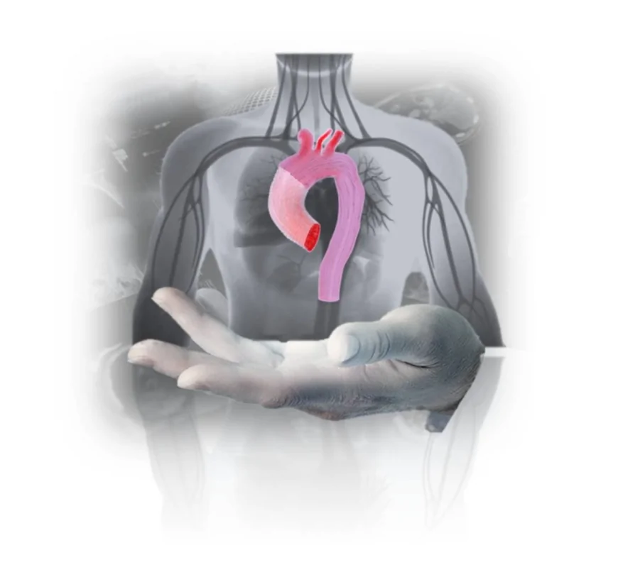 Progetto Pandora: modellazione in-silico per la chirurgia degli aneurismi aortici